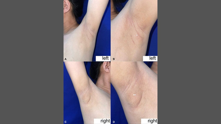 filipinli kadinin koltukaltindan sut geldi nadir gorulen durumun nedeni ne aTqRAwuy.jpg